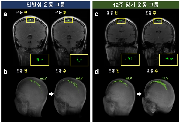 [그림 2] 단발성/장기 운동에 따른 뇌막림프관 영역 크기 변화 확인을 위한 MRI 영상